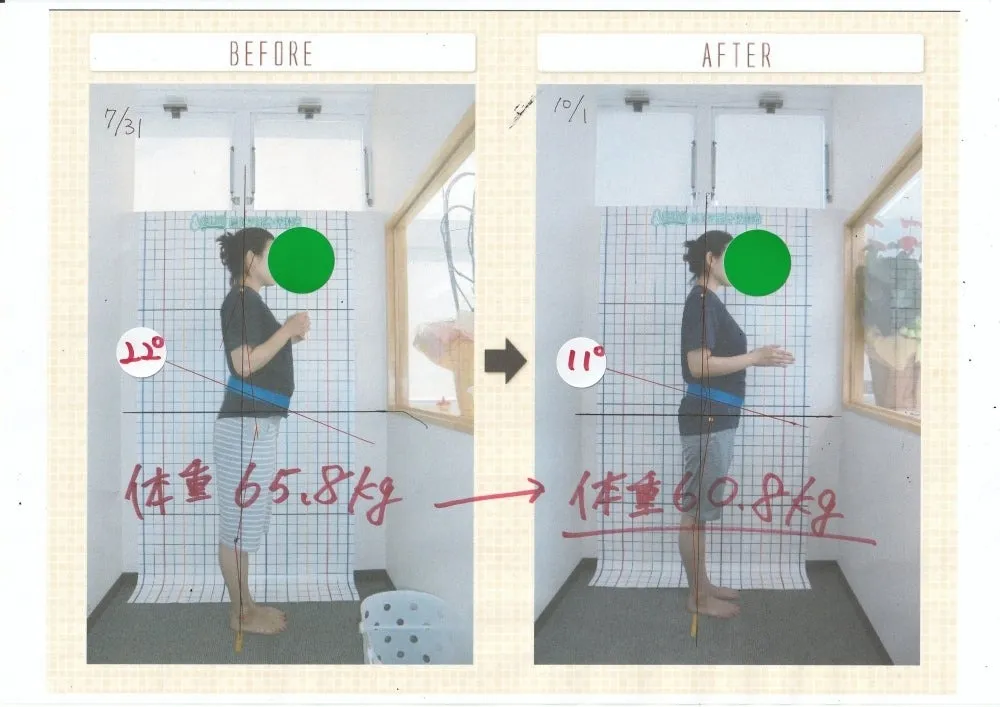 骨盤矯正・ビフォーアフター